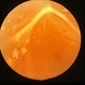 Diabetes Proliferative Diabetes Proliferative