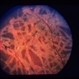 Ophthalmomyiasis