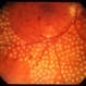 PRP laser PRP laser