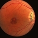Presumed Ocular Histoplasmosis Presumed Ocular Histoplasmosis