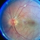 Roth Spots Leukemia Roth Spots Leukemia