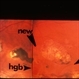 Serpiginous Choroidopathy With Macular Scarring