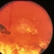 Serpiginous Choroidopathy With Macular Scarring