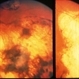 Serpiginous Choroidopathy With Macular Scarring