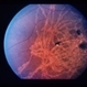 Ophthalmomyiasis