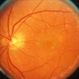 Senile Macular Degeneration Senile Macular Degeneration