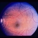 Ophthalmomyiasis