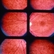 Flecks Retinopathy Flecks Retinopathy