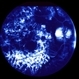 Ophthalmomyiasis