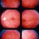 Flecks Retinopathy Flecks Retinopathy