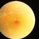 Diabetic Retinopathy Exudative