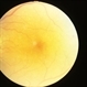 Diabetic Retinopathy Exudative