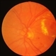 Diabetic Retinopathy Exudative