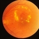 Diabetic Retinopathy Exudative Diabetic Retinopathy Exudative