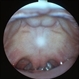 Stickler's Syndrome Bifid Uvula And Palate Stickler's Syndrome Bifid Uvula And Palate
