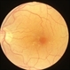 Exudative Diabetic Retinopathy