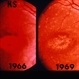 Bull's Eye Maculopathy With Flecks Bull's Eye Maculopathy With Flecks