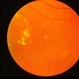 Diabetic Retinopathy Exudative Diabetic Retinopathy Exudative