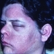 Herpes Zoster