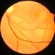 Multiple Vitelliforn Retinal 4