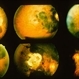 Subretinal Hemorrhage 4 Subretinal Hemorrhage 4