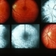Inflammation Inflammation