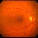 Hypertensive Retinopathy Hypertensive Retinopathy