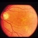 Pattern Dystrophy