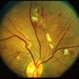 Preproliferative Diabetic Retinopathy Preproliferative Diabetic Retinopathy