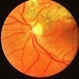 Branch Vein Occlusion With Laser Branch Vein Occlusion With Laser
