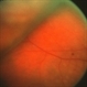 Probable Choroidal Infarcts After Buckle Probable Choroidal Infarcts After Buckle