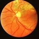 Branch vein occlusion with laser Branch vein occlusion with laser