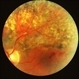 Branch Vein Occlusion With Laser Branch Vein Occlusion With Laser