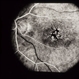 Pattern Dystrophy