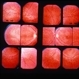 Fleck Retinopathy Fleck Retinopathy