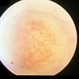 Central Macular Lesion, Choroidal Hemangioma, Staphyloma Central Macular Lesion, Choroidal Hemangioma, Staphyloma