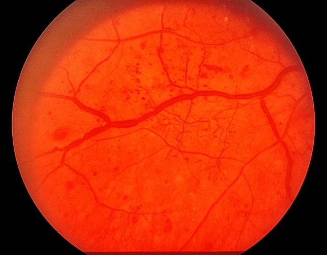 exam bank for Retina Image Venous Bank & Beading NVE exam bank for Retina Image Venous Bank & Beading NVE