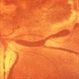 Venous Beading