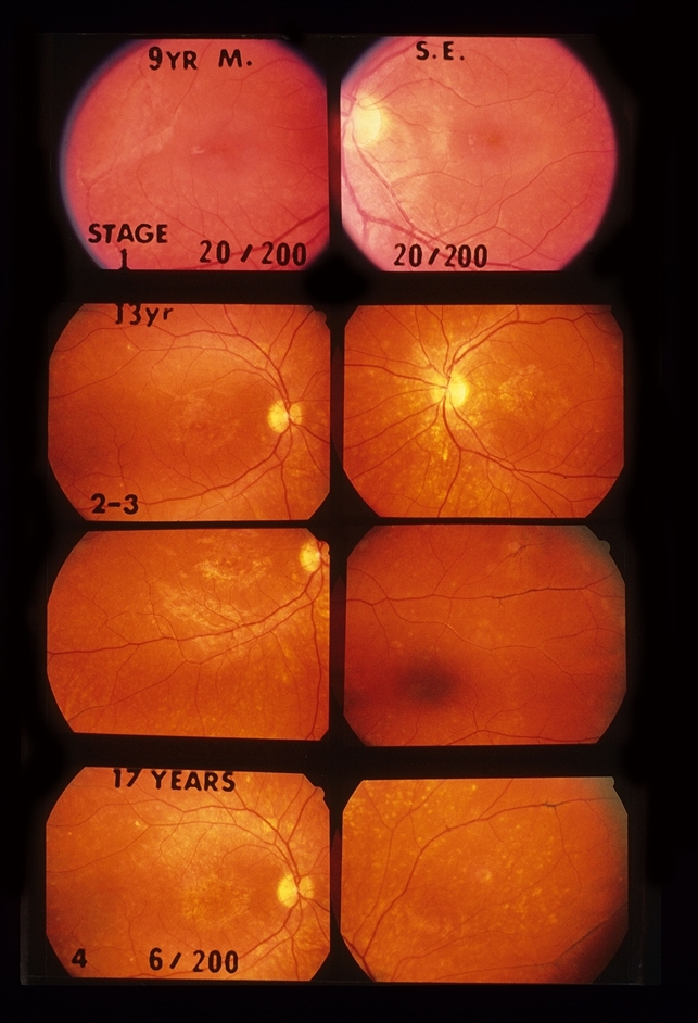 Pattern Dystrophy Retina Image Bank