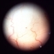 Fabry`s disease Fabry`s disease