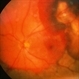 Choroidal And Subretinal Hemorrhage
