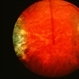 Central Hemorrhagic Disciform Lesion Resolved