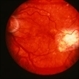 Central Hemorrhagic Disciform Lesion Resolved