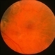 Central Hemorrhagic Disciform Lesion Resolved