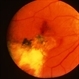 Central Hemorrhagic Disciform Lesion Resolved