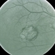 Old Laser (Treated Disciform) With Treated Recurrence Old Laser (Treated Disciform) With Treated Recurrence