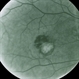 Old Laser (Treated Disciform) With Recurrence Old Laser (Treated Disciform) With Recurrence