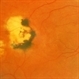 Old Macular Scar Old Macular Scar