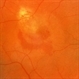 Eccentric Macular Scar With Recurrence Eccentric Macular Scar With Recurrence