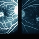 FA Fleck Retinopathy With Dark Choroid Stargardt FA Fleck Retinopathy With Dark Choroid Stargardt